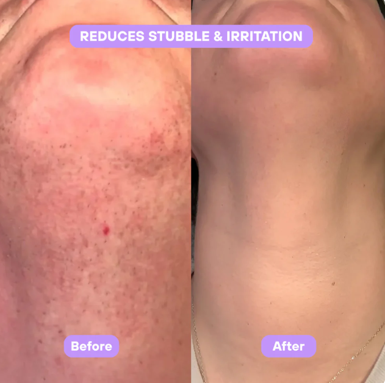 Cyperus Rotundus Skin Serum